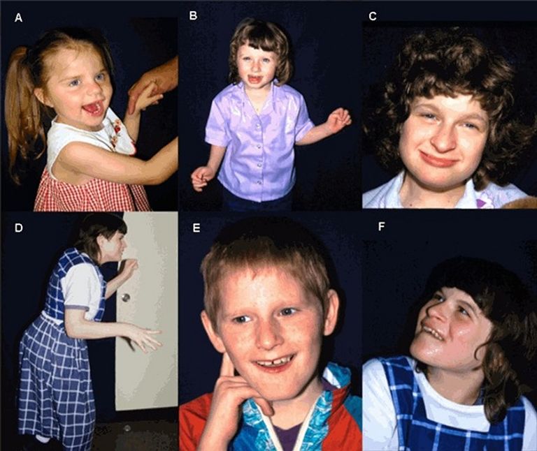 أسباب جينية تقف خلف الإصابة بمتلازمة أنجلمان