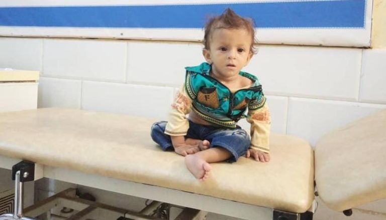 طفل يمني يعاني الهزال لندرة مصادر الغذاء الصحي