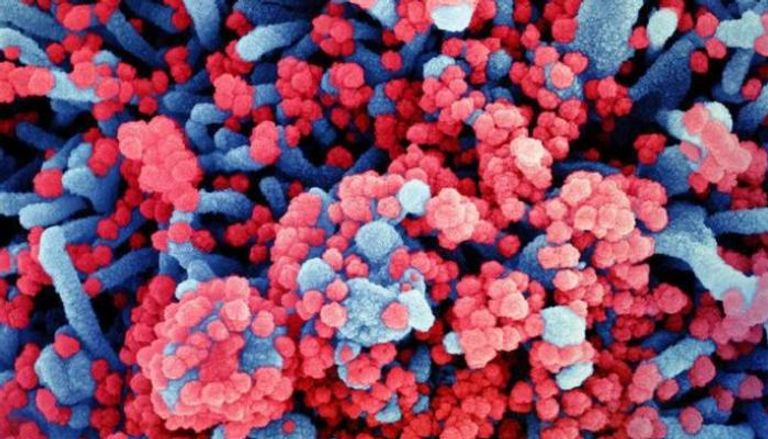 صورة مجهرية لخلية (زرقاء) مصابة بشدة بجزيئات كورونا "اللون الأحمر"