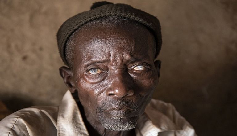 العمى النهري ثاني أكبر سبب للعمى الناتج عن العدوى - أرشيفية