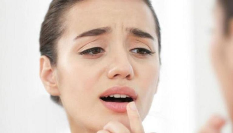 تشقق زوايا الفم قد يرجع إلى أحد الأمراض الجلدية