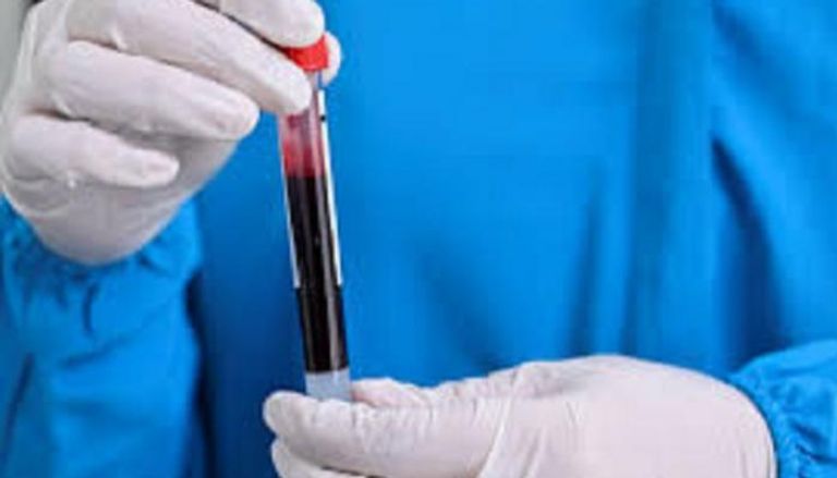 مؤشرات بالدم يمكن أن تكشف الحالات الخطيرة من كوفيد -19