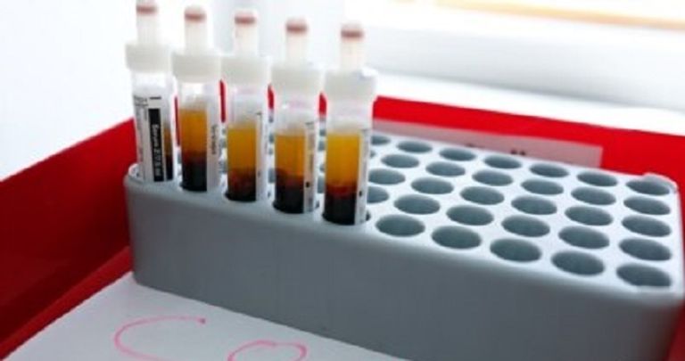 مؤشرات بالدم يمكن أن تكشف الحالات الخطيرة من كوفيد -19