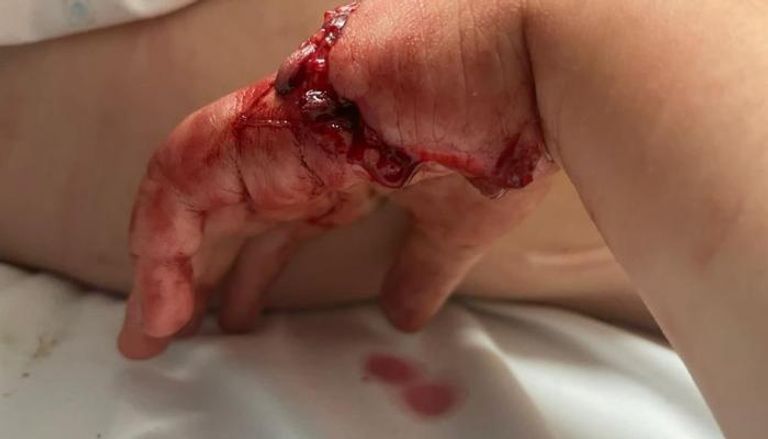 إصابات بالغة في يد الطفل 