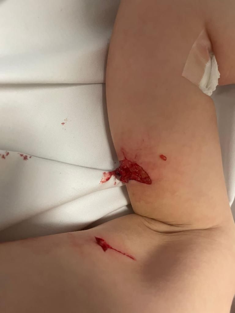 إصابات بالغة في يد الطفل