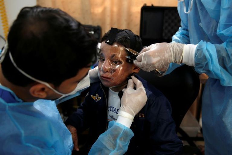 أقنعة ثلاثية الأبعاد لضحايا حروق الوجه في غزة