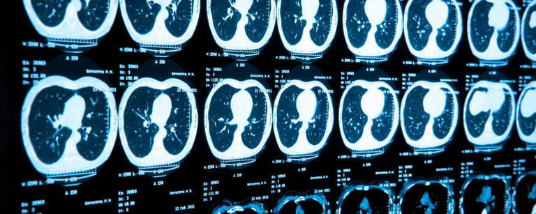 فحوصات الرئة يمكنها التنبؤ بمن سيواجه مشاكل عصبية محتملة، جراء الإصابة بكورونا