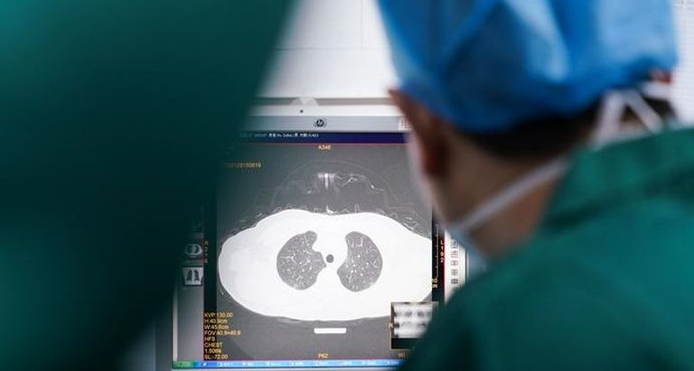 فحوصات الرئة يمكنها التنبؤ بمن سيواجه مشاكل عصبية محتملة، جراء الإصابة بكورونا