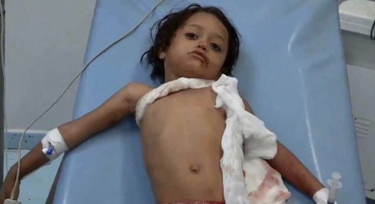 الطفلة "ريماس" أحد ضحايا قذائف الحوثي بالحديدة قذائف مليشيا الحوثي على منازل المدنيين