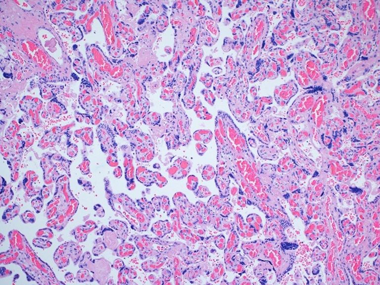 نظرة مجهرية على المشيمة في الدراسة ، والتي لم تتضرر من لقاح كوفيد -19 سيدة حامل تتلقى لقاح (كوفيد -19)