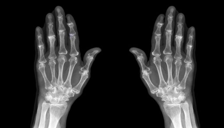صورة أشعة تظهر هشاشة العظام في الأطراف