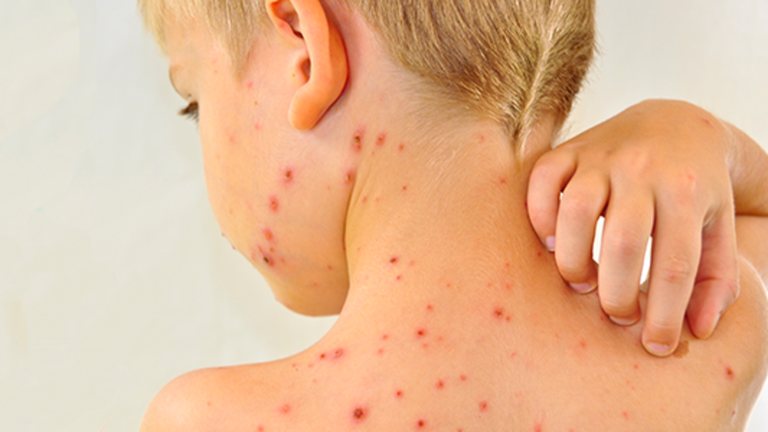 طفل يعاني من مرض الحصبة