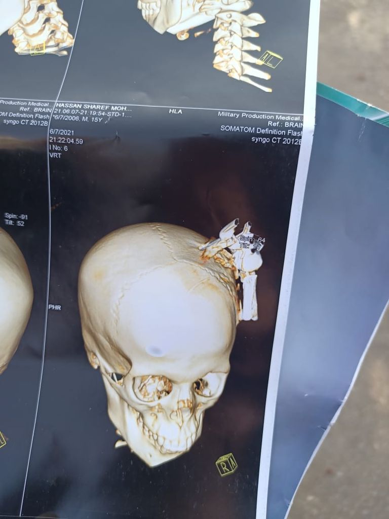 الطفل المصاب