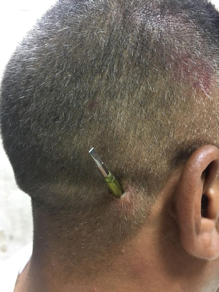 المفك بعد استخراجه من رأس المريض