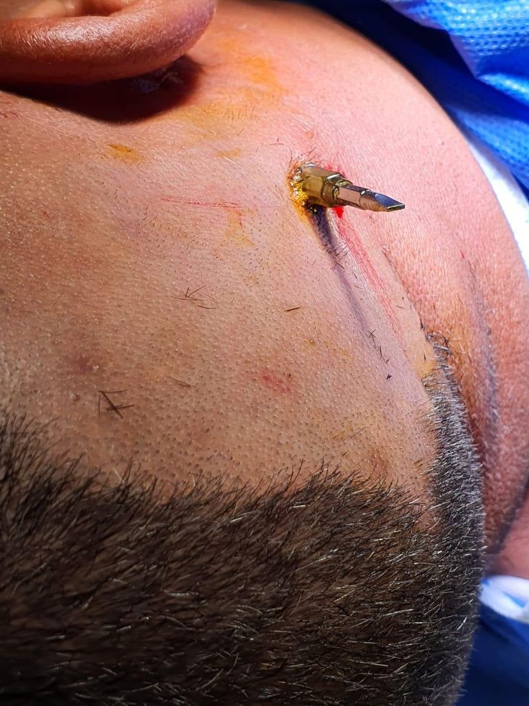 المفك بعد استخراجه من رأس المريض