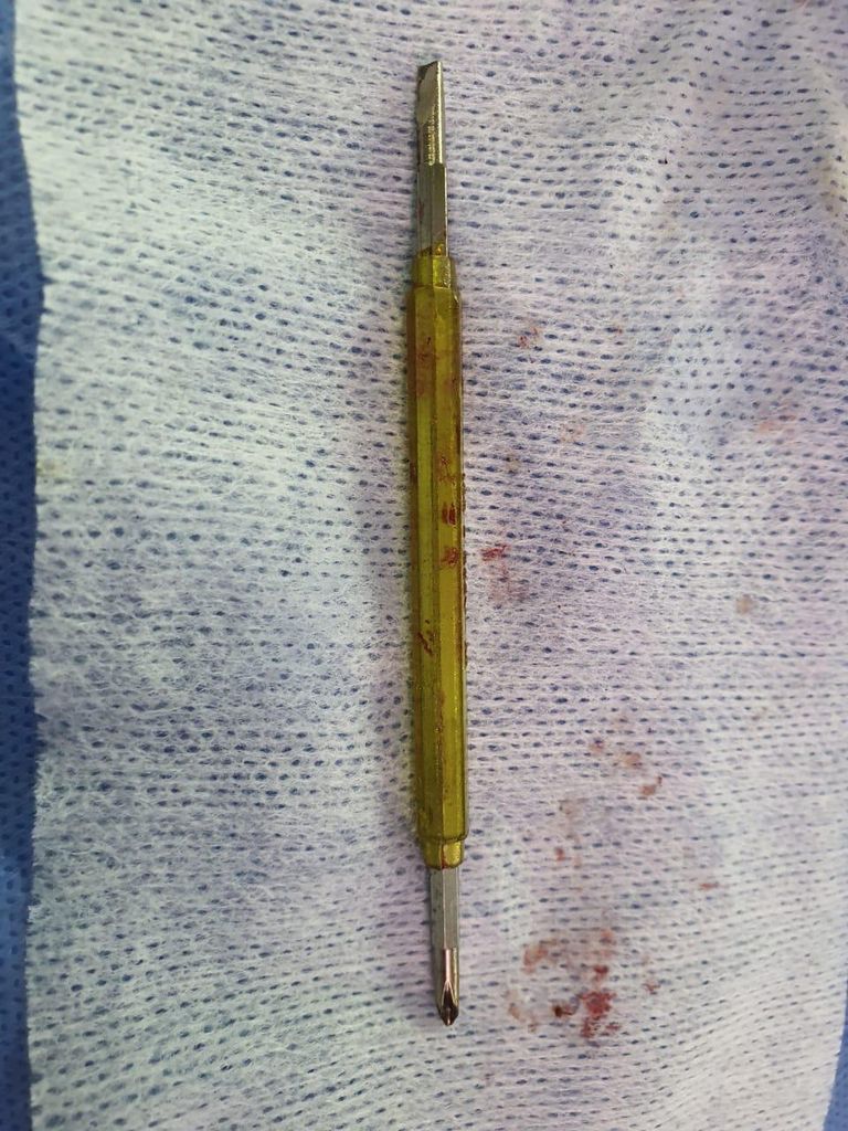 المفك بعد استخراجه من رأس المريض