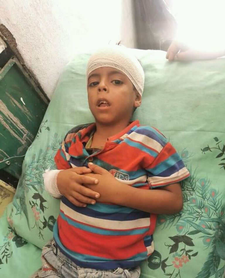 الطفل اليمني المصاب علي عرفات الحماطي قصف حوثي سابق لمنازل المدنيين في اليمن - أرشيفية