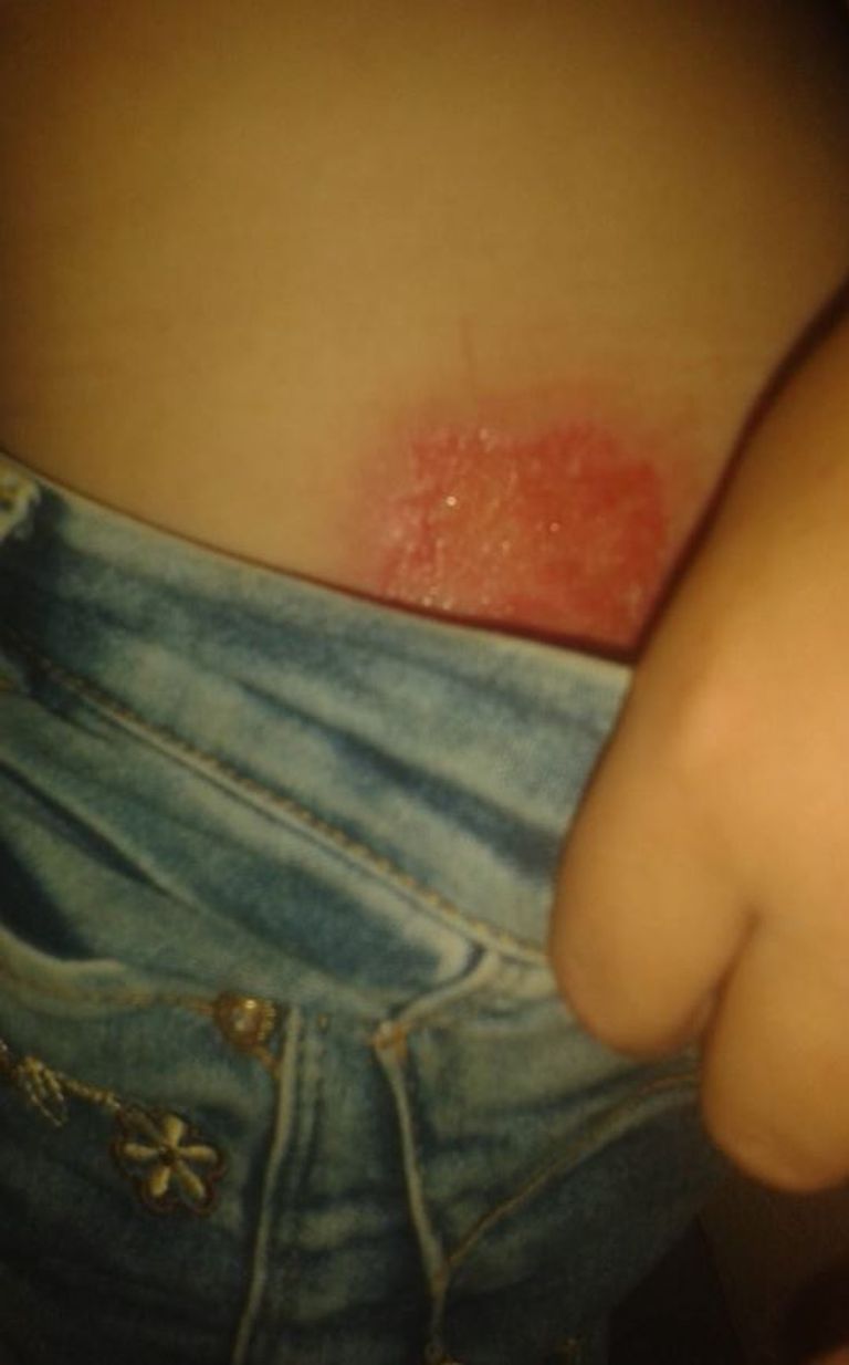 آثار التعذيب بجسد الطفلة