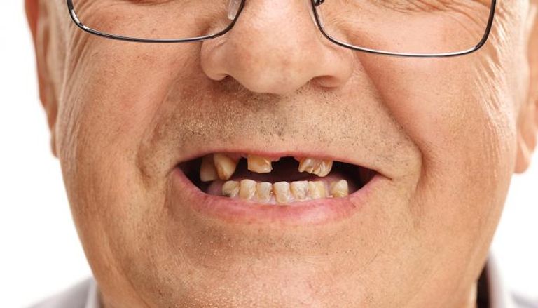 فقدان الأسنان يزيد خطر الإصابة بالخرف لدى كبار السن