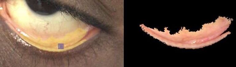 الملتحمة الجفنية تبدو أكثر شحوبًا مع فقر الدم