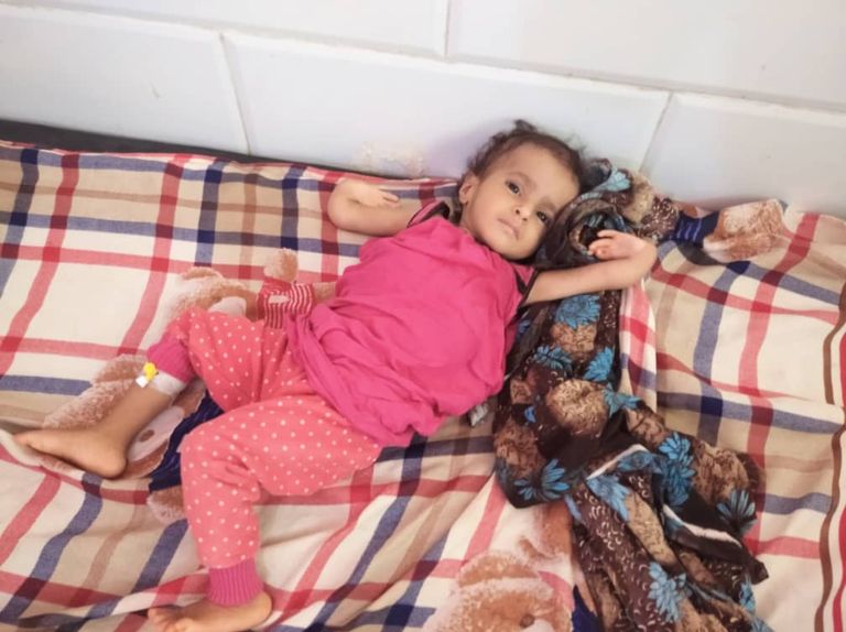 طفل يمني يعاني من سوء التغذية