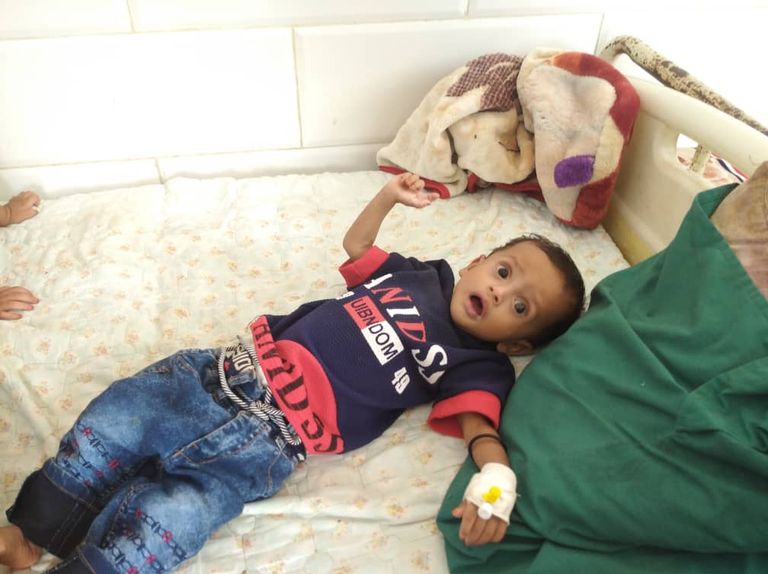 طفل يمني يعاني من سوء التغذية