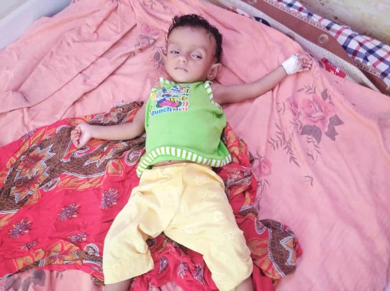 طفل يمني يعاني من سوء التغذية