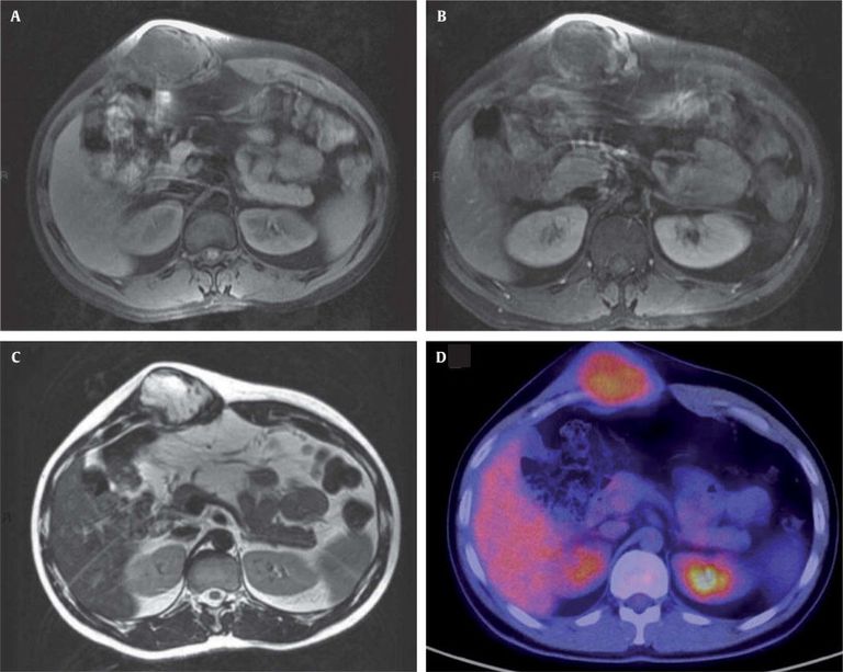 لأول مرة في إيطاليا.. تجميد ورم نادر بالعلاج بالتبريد