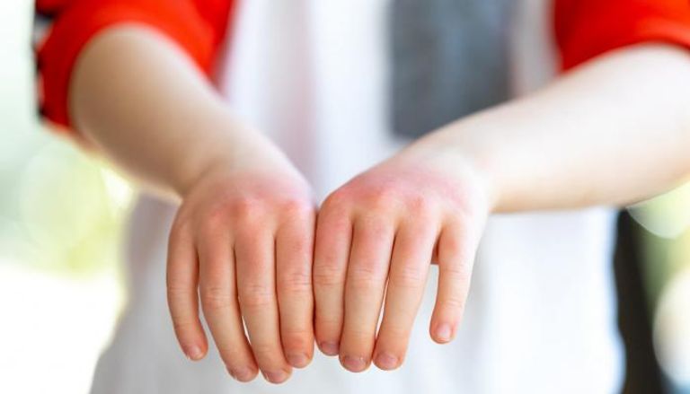  أعراض إكزيما اليد تتمثل في الاحمرار والتقشر