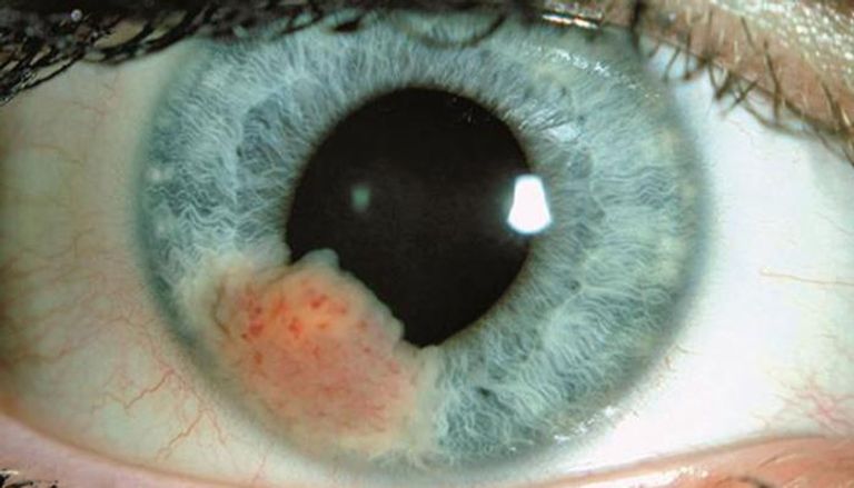 الورم الميلانيني العنبي أو سرطان العين يصيب مريضا من كل 3 مرضى