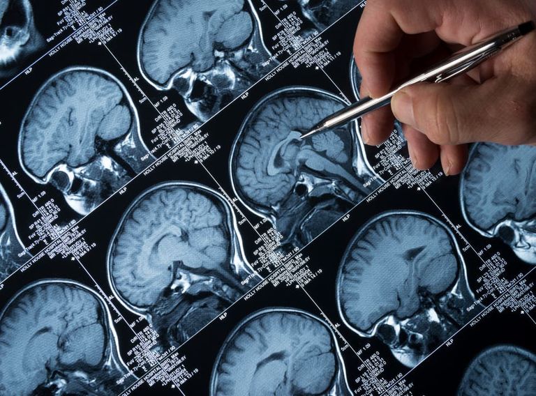 مرض ألزهايمر هو الشكل الأكثر شيوعاً للخرف