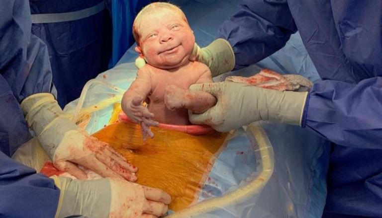 طفل يخرج للحياة بعد ولادة قيصرية