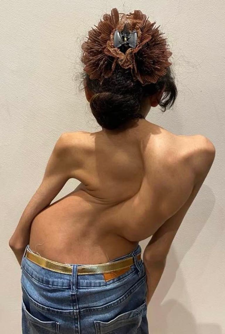 الطفلة ماريا بعد 6 ساعات من إجراء عملية إصلاح الإعوجاج بعمودها الفقري