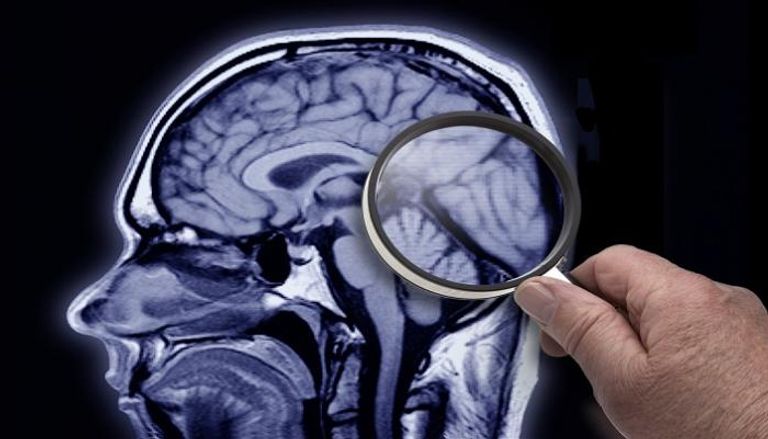 علامات تلف الدماغ تظهر لدى مصابي كورونا أكثر من مرضى ألزهايمر- أرشيفية