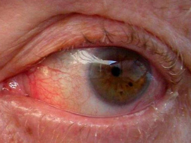 شخص مصاب بمرض الجلوكوما