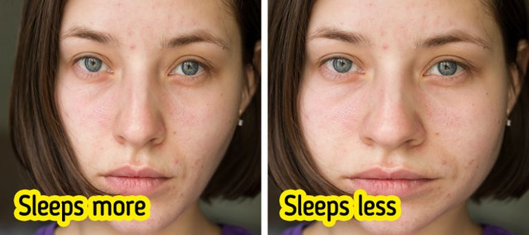 عدم توازن هرموني الجوع والشبع الناتج عن قلة النوم يؤدي إلى زيادة الوزن