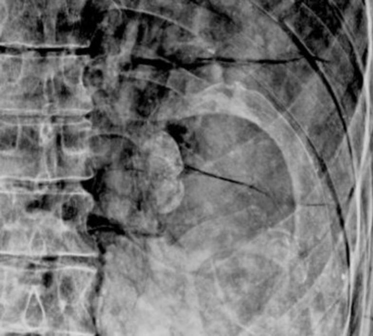 المومياء التي أجريت عليها الدراسة كانت محفوظة في كارتوناج 