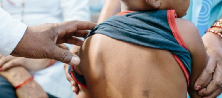 فتاة مصابة بمرض الجذام