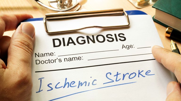 تحدث السكتة الدماغية الإقفارية عند انسداد الأوعية الدموية- أرشيفية