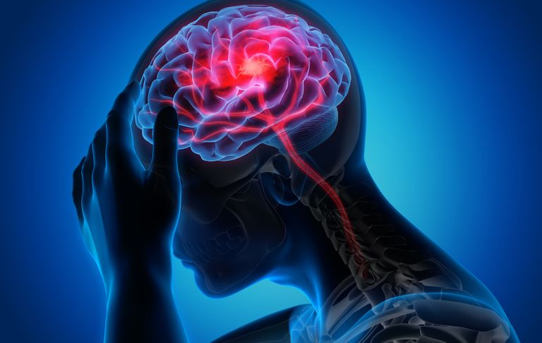 تحدث السكتة الدماغية الإقفارية عند انسداد الأوعية الدموية- أرشيفية