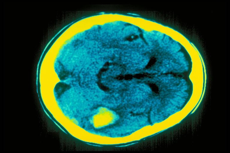 تحدث السكتة الدماغية الإقفارية عند انسداد الأوعية الدموية- أرشيفية