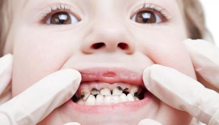 أسنان مصابة بالتسوس- أرشيفية