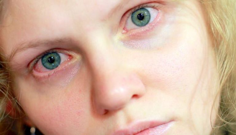 يشمل علاج التهاب قزحية العين الكورتيزون