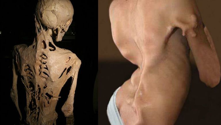 خلل التنسج الليفي العظمي التدريجي- أرشيفية