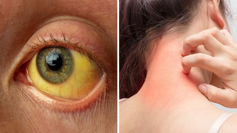 شخص مصاب بآلام في الكبد - أرشيفية