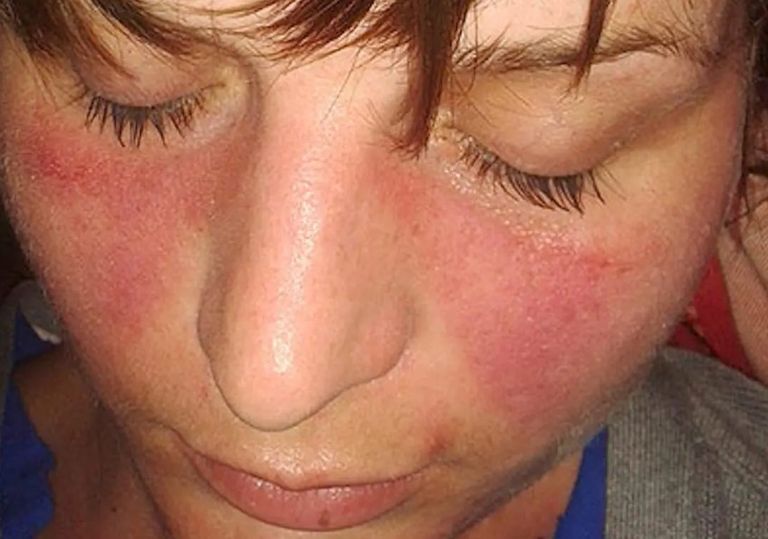 آثار الذئبة الحمراء على وجه فتاة - أرشيفية