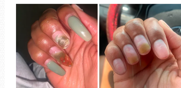 الفطريات أسفل الأظافر الصناعية