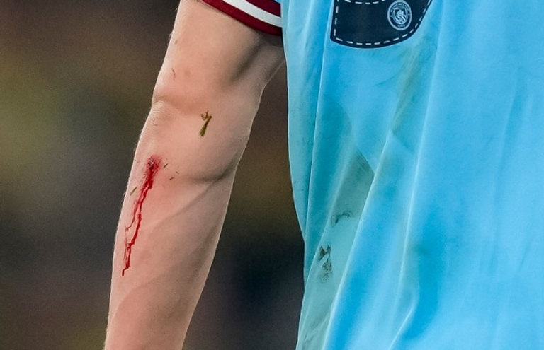 هالاند ينزف دماً إصابة إيرلينج هالاند