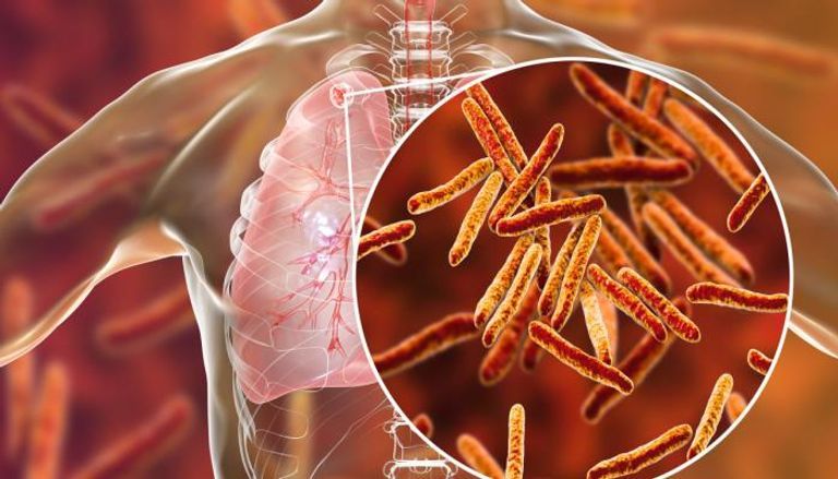 جائحة كورونا قوضت جهود مكافحة السل- أرشيفية