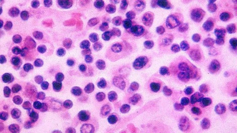 سيدة تعاني من أعراض التيفود - أرشيفية